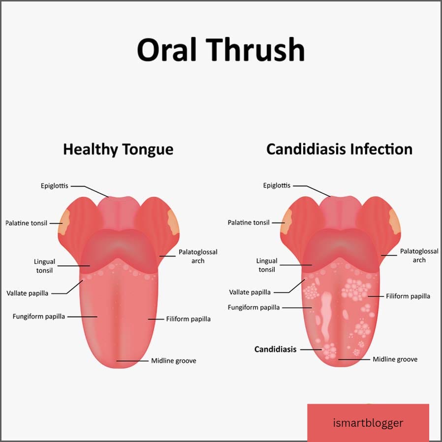 Best home remedies for Oral thrush